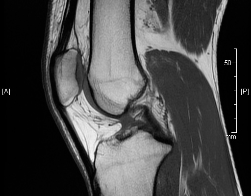 ¿Es cierto que un ligamento cruzado roto sin operar puede causar artrosis en la rodilla?